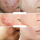 Creme Facial Anti-Acne